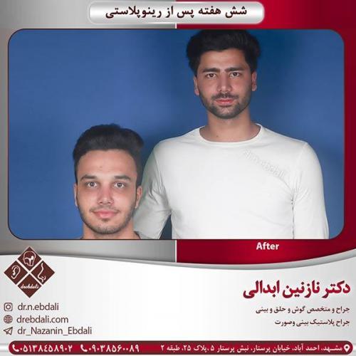 جراحی-بینی-مشهد-11
