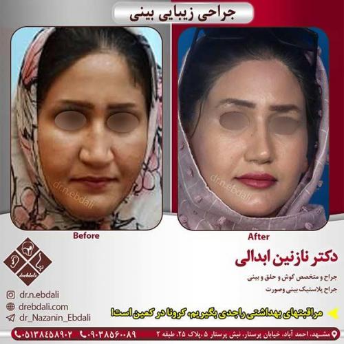 جراحی-بینی-مشهد-110