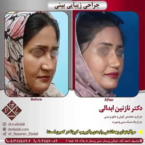 جراحی-بینی-مشهد-111