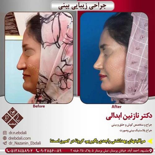 جراحی-بینی-مشهد-112