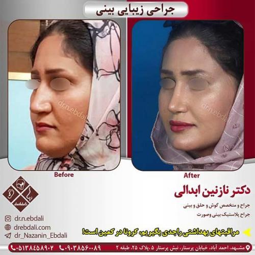 جراحی-بینی-مشهد-113