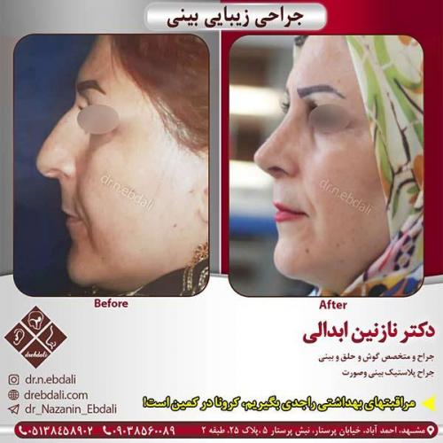 جراحی-بینی-مشهد-114