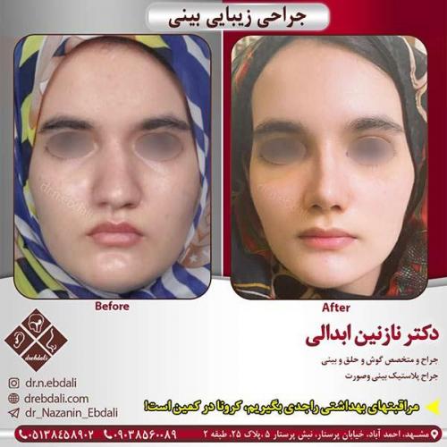 جراحی-بینی-مشهد-115