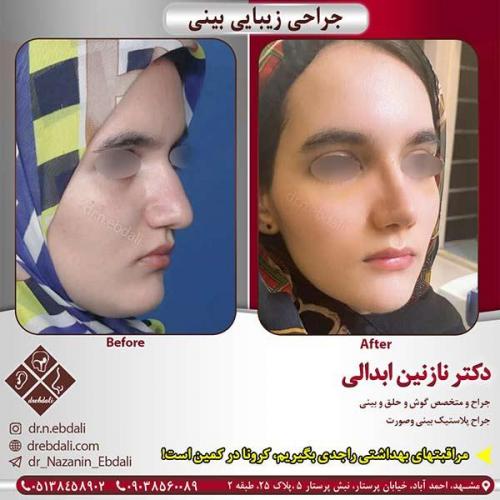 جراحی-بینی-مشهد-116