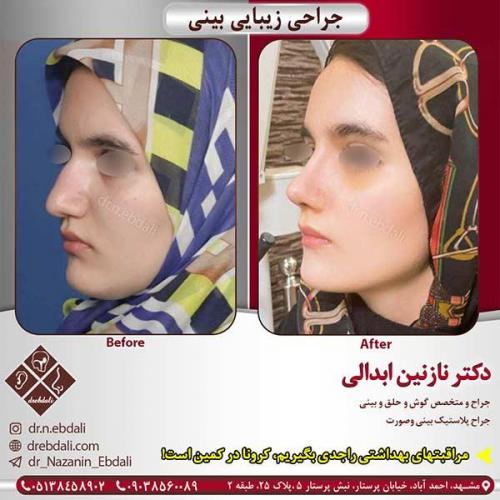 جراحی-بینی-مشهد-117