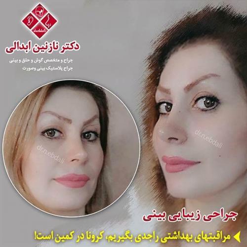 جراحی-بینی-مشهد-118