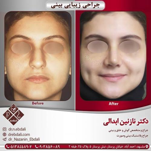 جراحی-بینی-مشهد-12