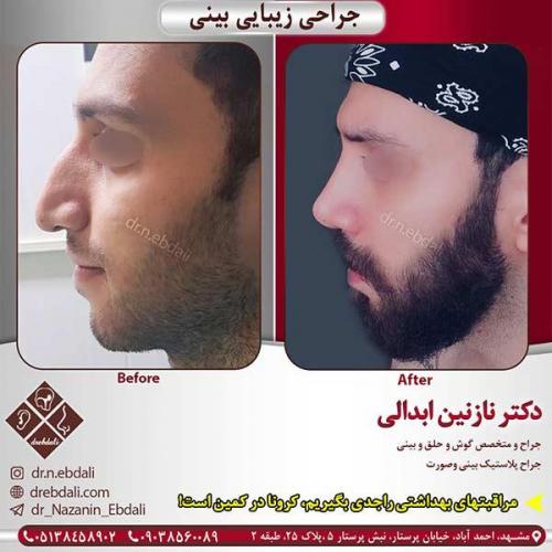 جراحی-بینی-مشهد-121