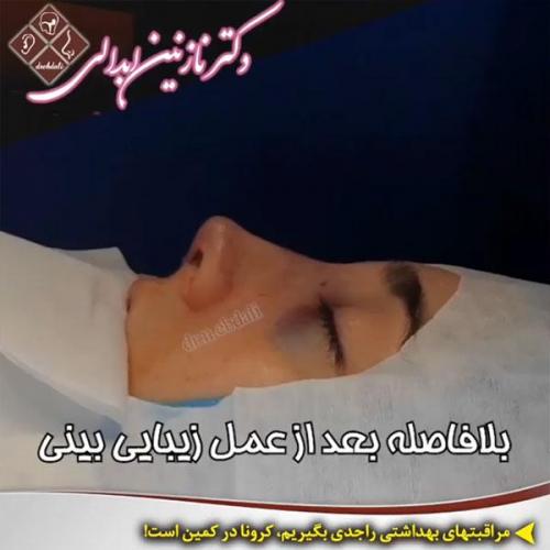 جراحی-بینی-مشهد-122