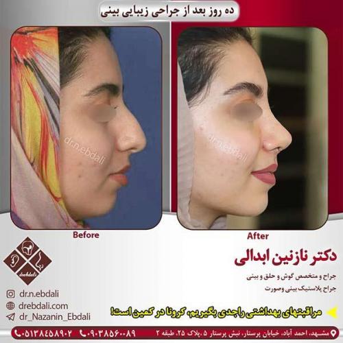 جراحی-بینی-مشهد-125