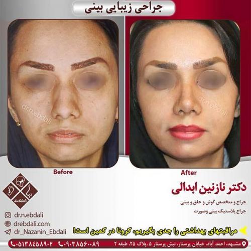 جراحی-بینی-مشهد-127
