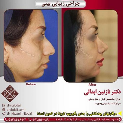 جراحی-بینی-مشهد-128