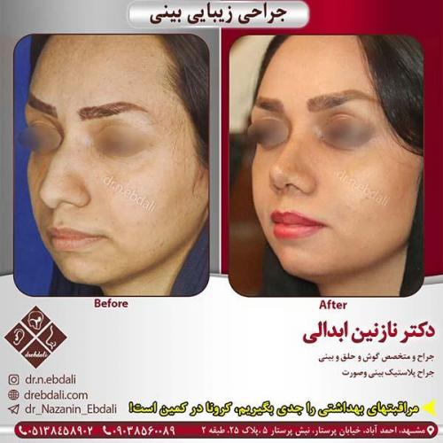 جراحی-بینی-مشهد-129