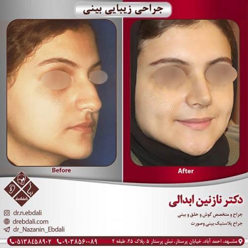 جراحی-بینی-مشهد-13
