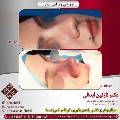 جراحی-بینی-مشهد-132