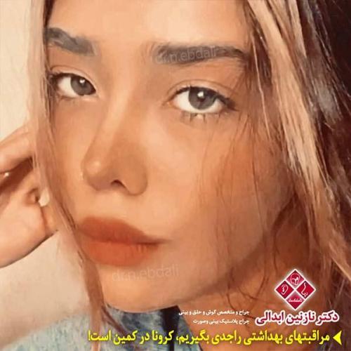 جراحی-بینی-مشهد-133