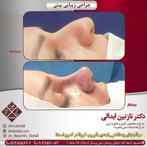 جراحی-بینی-مشهد-135