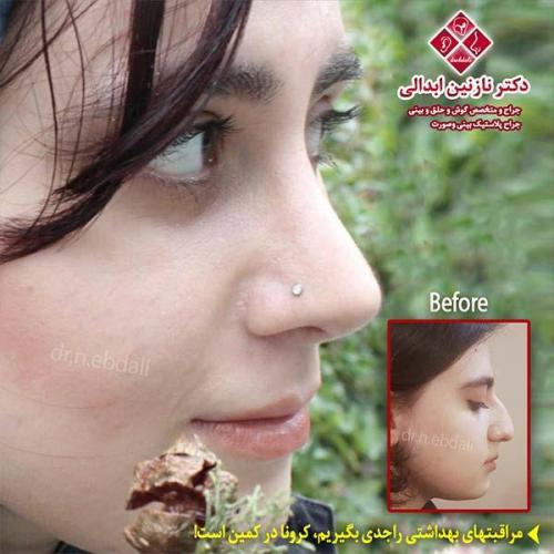 جراحی-بینی-مشهد-136