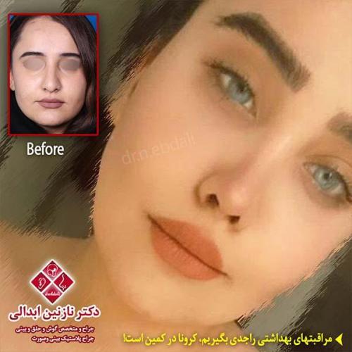 جراحی-بینی-مشهد-137