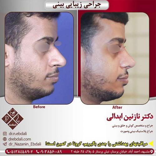 جراحی-بینی-مشهد-138