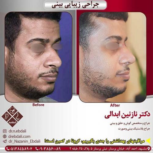 جراحی-بینی-مشهد-139