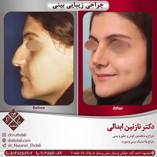 جراحی-بینی-مشهد-14
