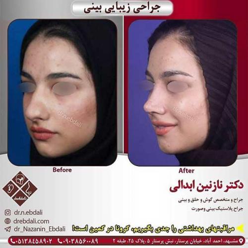 جراحی-بینی-مشهد-140