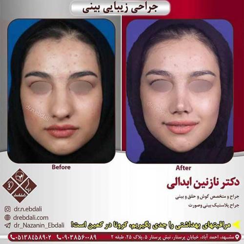 جراحی-بینی-مشهد-141