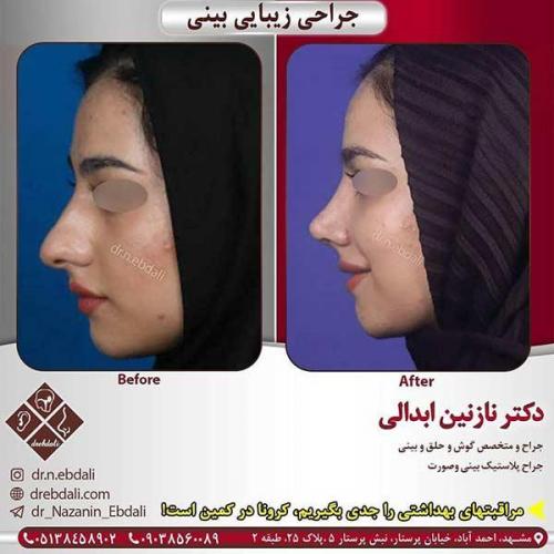 جراحی-بینی-مشهد-142