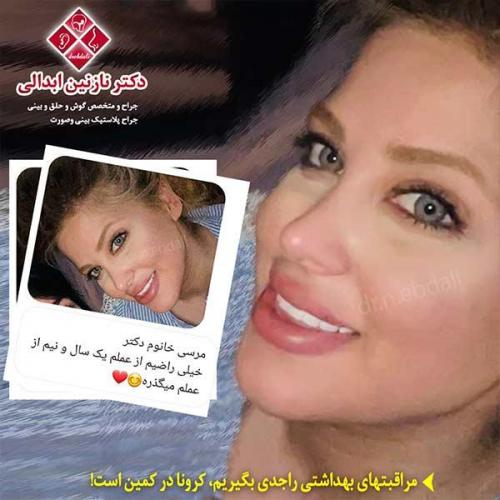 جراحی-بینی-مشهد-143
