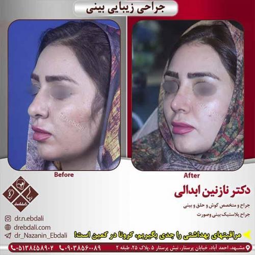 جراحی-بینی-مشهد-147