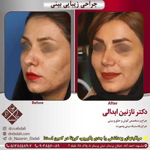 جراحی-بینی-مشهد-148