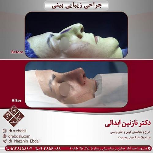 جراحی-بینی-مشهد-15
