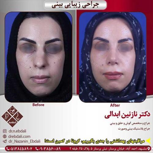 جراحی-بینی-مشهد-151