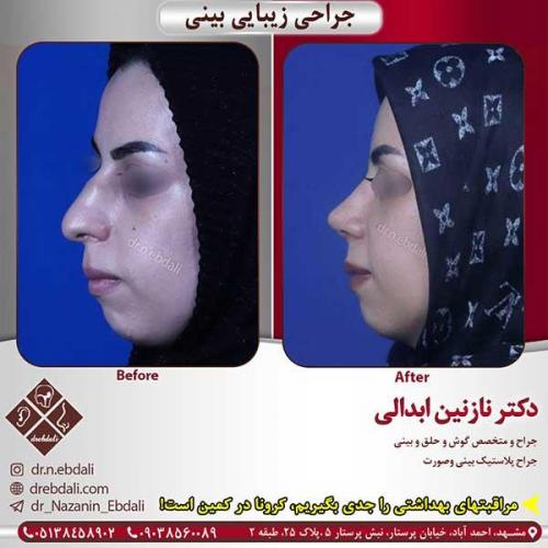 جراحی-بینی-مشهد-152
