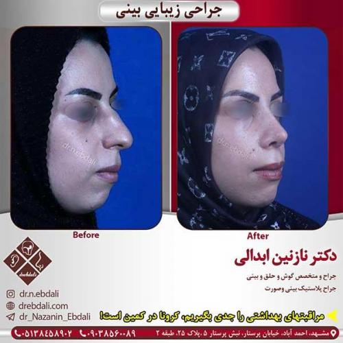 جراحی-بینی-مشهد-153