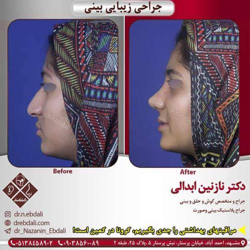 جراحی-بینی-مشهد-154