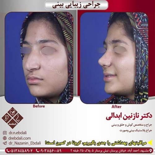 جراحی-بینی-مشهد-155
