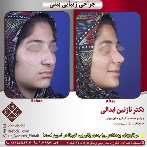 جراحی-بینی-مشهد-157