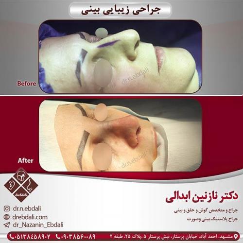 جراحی-بینی-مشهد-16