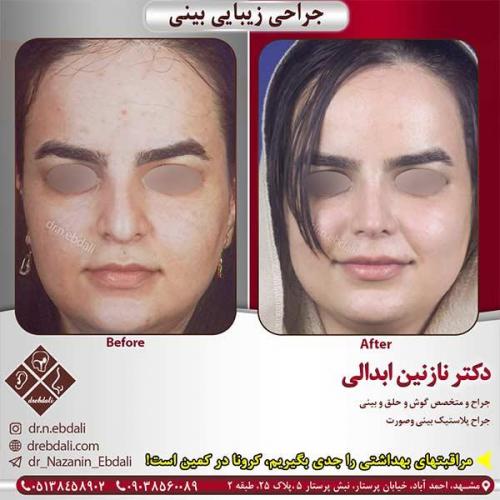 جراحی-بینی-مشهد-160