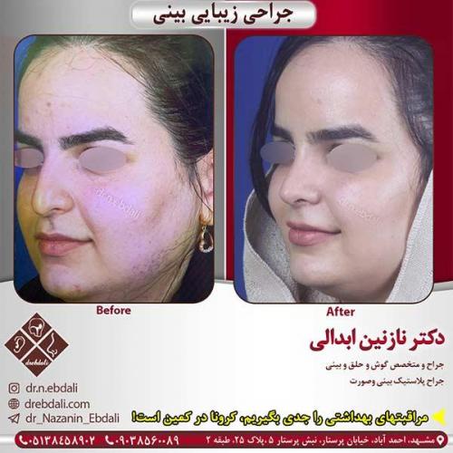 جراحی-بینی-مشهد-161