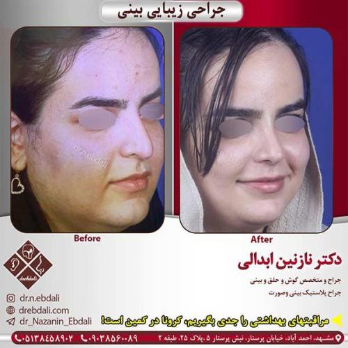 جراحی-بینی-مشهد-162