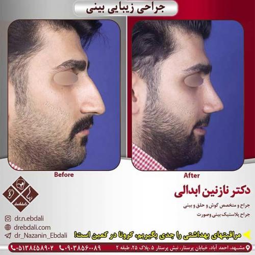 جراحی-بینی-مشهد-163