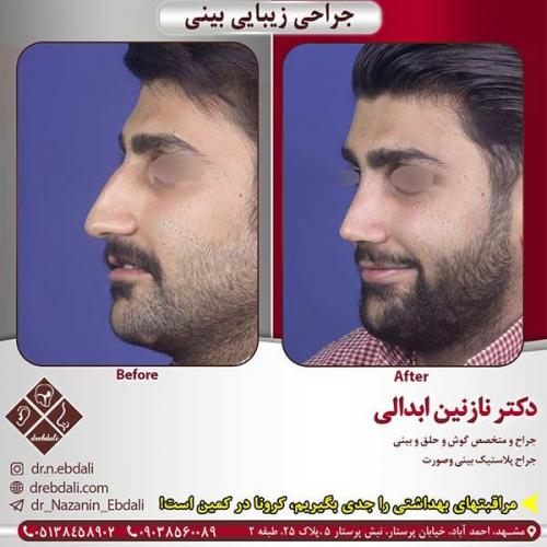 جراحی-بینی-مشهد-164