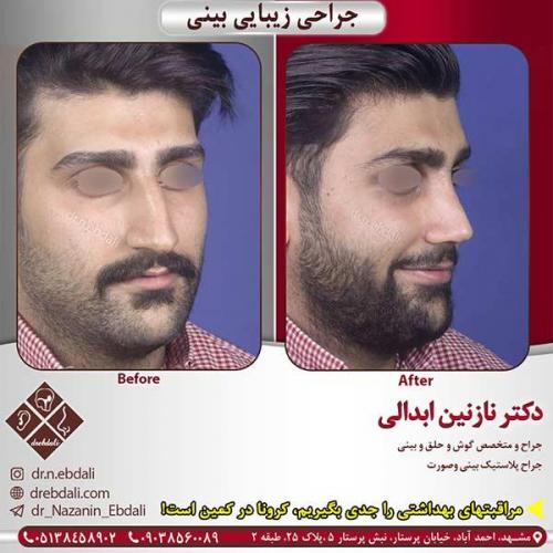 جراحی-بینی-مشهد-165