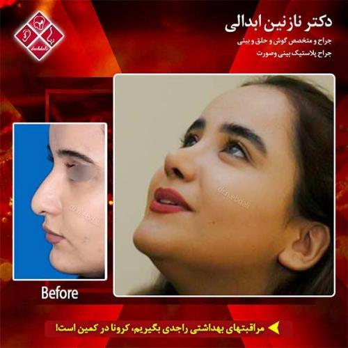 جراحی-بینی-مشهد-166