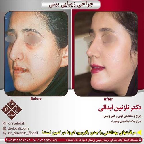 جراحی-بینی-مشهد-167