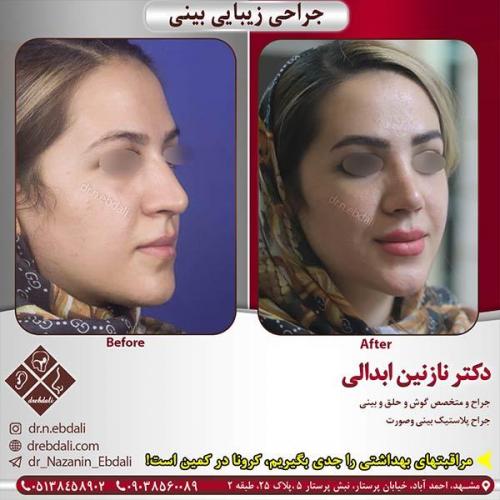 جراحی-بینی-مشهد-174