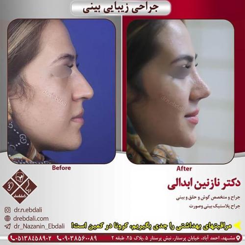 جراحی-بینی-مشهد-175